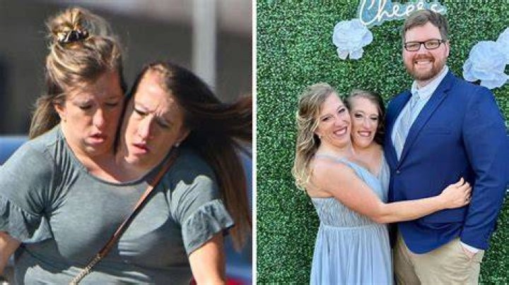 Hensel Twins Sad News Understanding Their Journey And Challenges