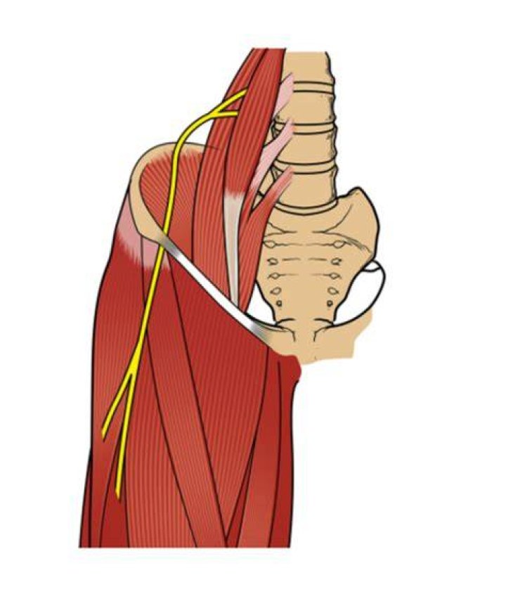 Top Tips for Meralgia Paresthetica &mdash; ChiroUp